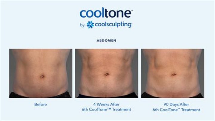 How do I maximize CoolSculpting results?