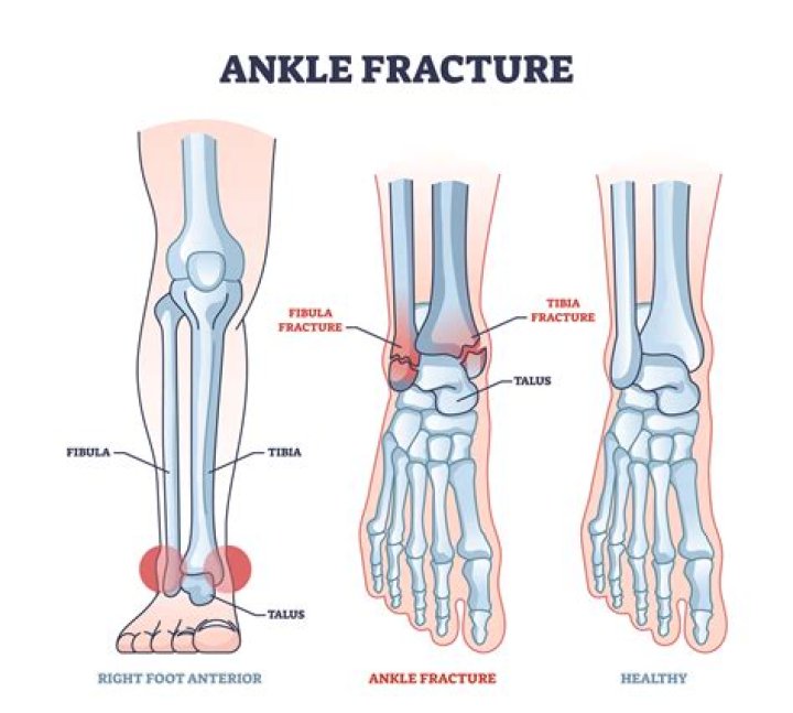 Why is my ankle stiff after fracture?